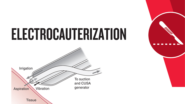 Guide for Electro Cauterization